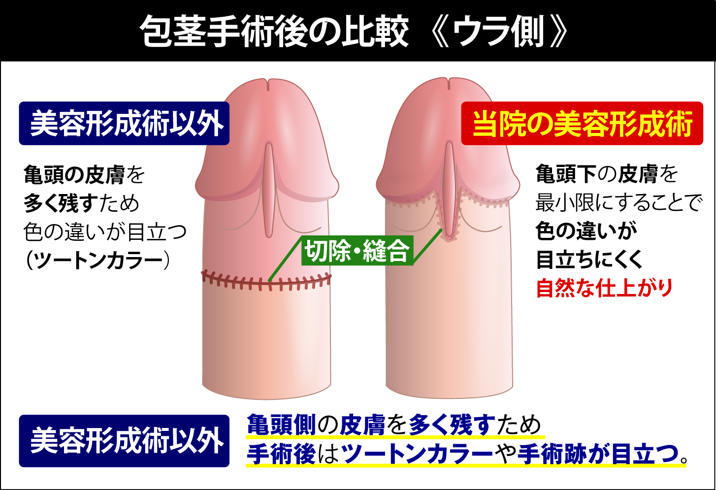 包茎手術後の比較（ウラ側）