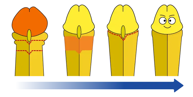 カントン包茎の亀頭直下埋没法