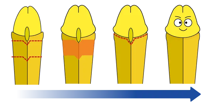 仮性包茎の亀頭直下埋没法