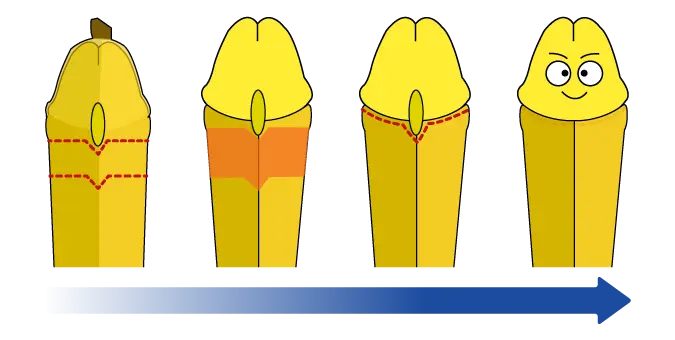 真性包茎の亀頭直下埋没法